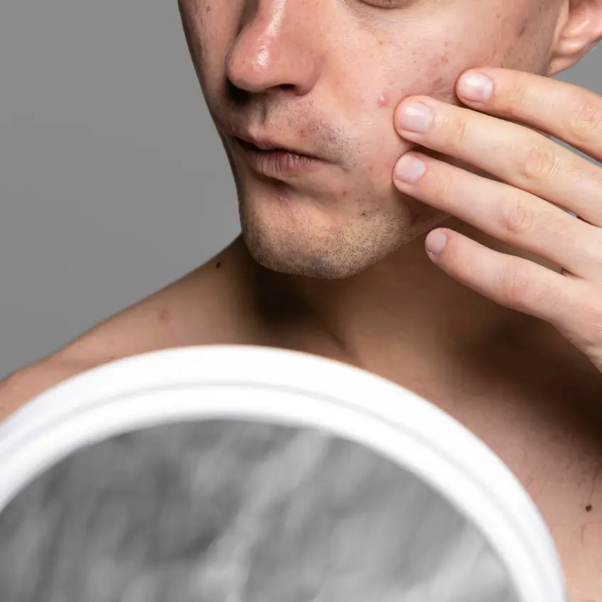 What is acne, really? What is acne, really?