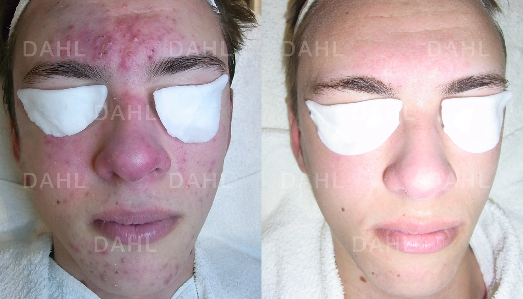 Helhetsresultat akne Total hudförbättring i ansiktet med DAHL Skincare