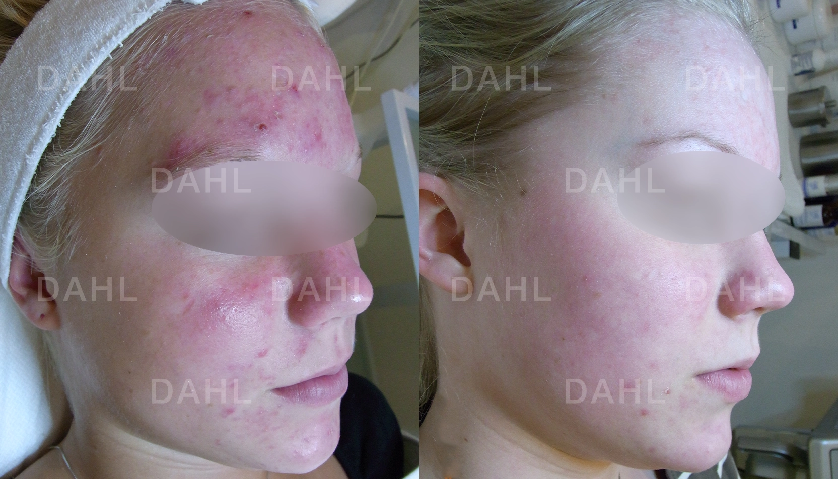 Lugnare och mindre inflammerad hud Inflammerad akne före och efter - DAHL Skincare