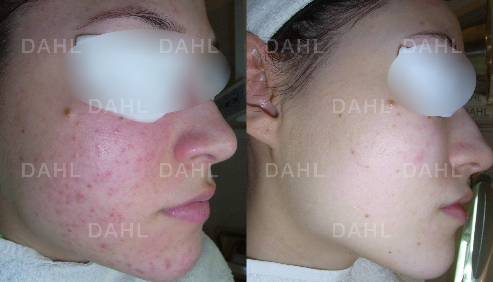 Förbättrad akne på kind Före- och efterbild av aknebehandling på kind med DAHL Skincare
