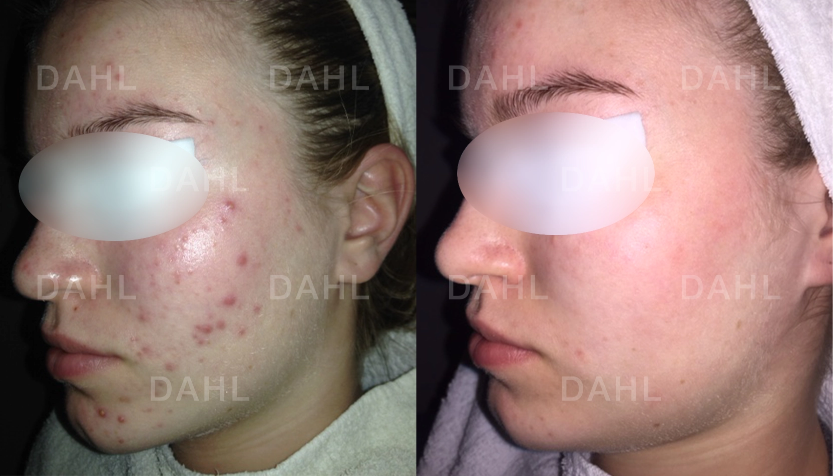 Mild akne under kontroll Före och efter mild akne - DAHL Skincare