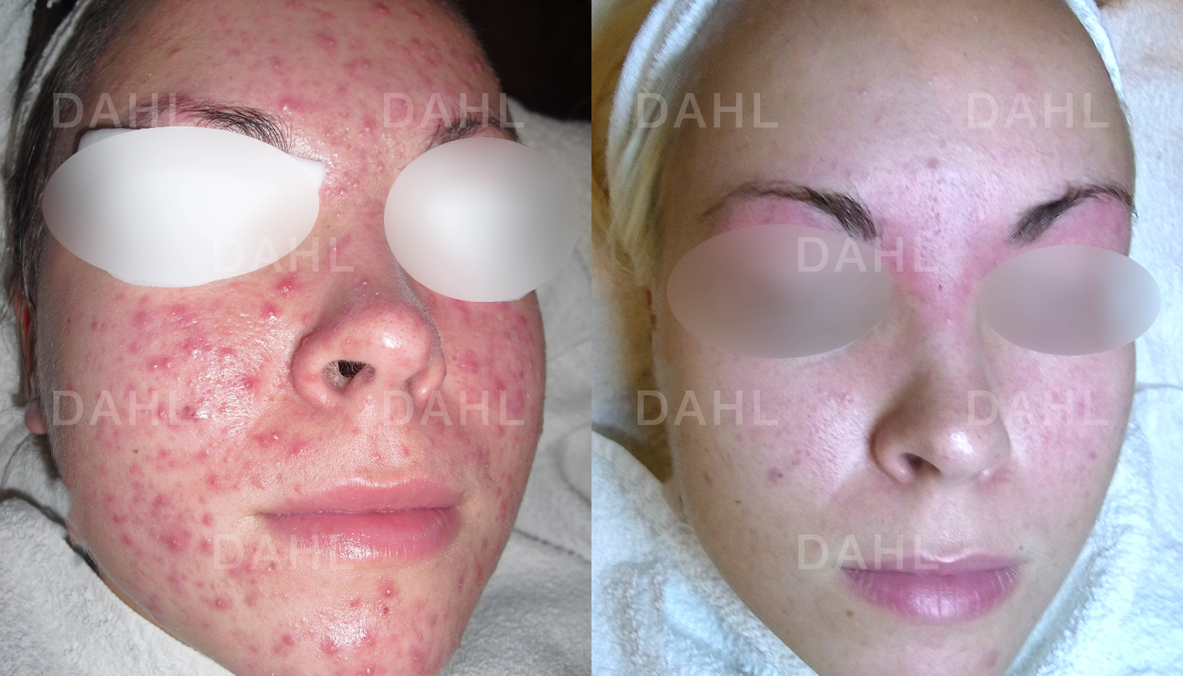 Märkbar förbättring vid omfattande akne Utbredd akne före och efter behandling