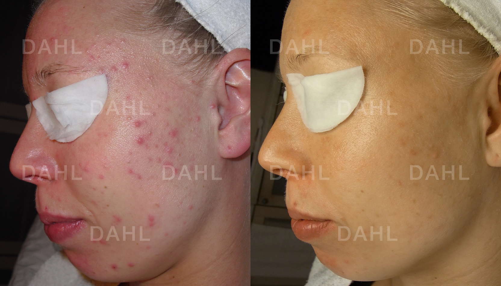 Balanserad blandhy helhet Blandhy före och efter - helhetsresultat