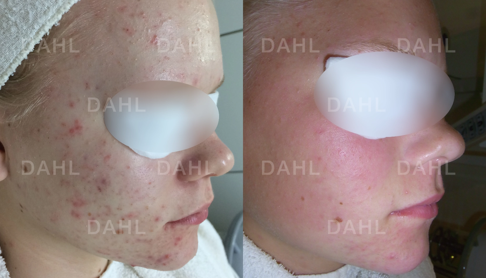 Renare hud utan pormaskar Pormaskar före och efter - helhetsresultat från DAHL Skincare