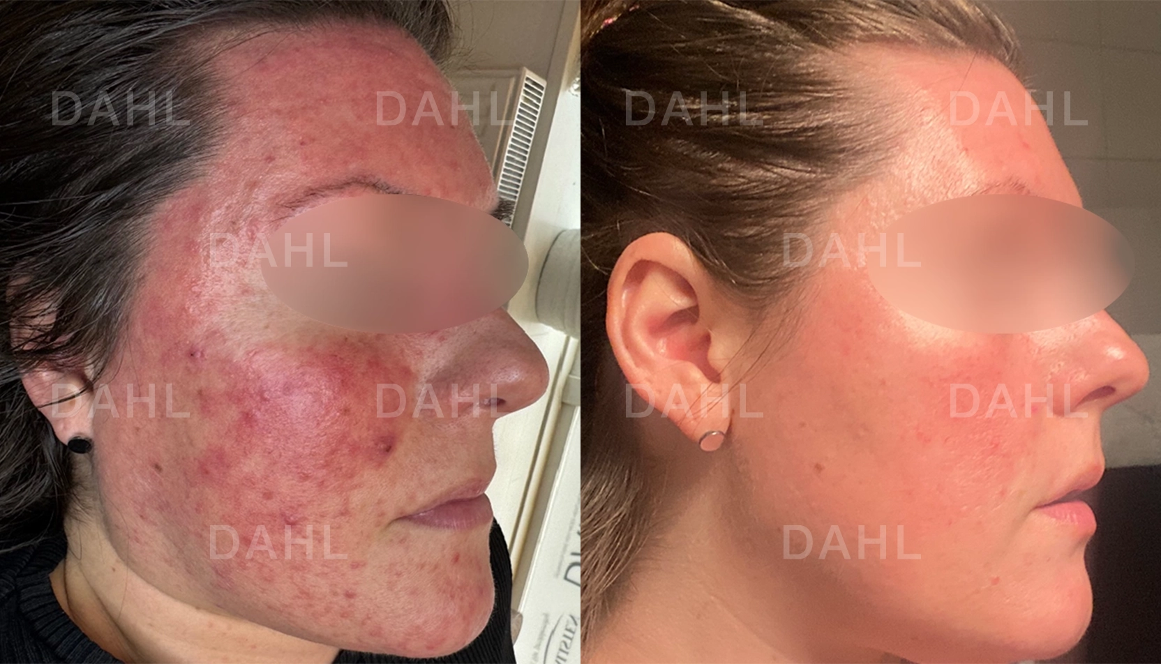 Jämnare höger kind Rosacea höger sida - behandlingsresultat