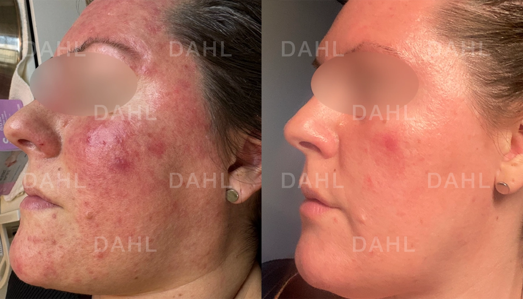 Förbättrad rosacea vänster sida Rosacea vänster kind - behandlingsresultat