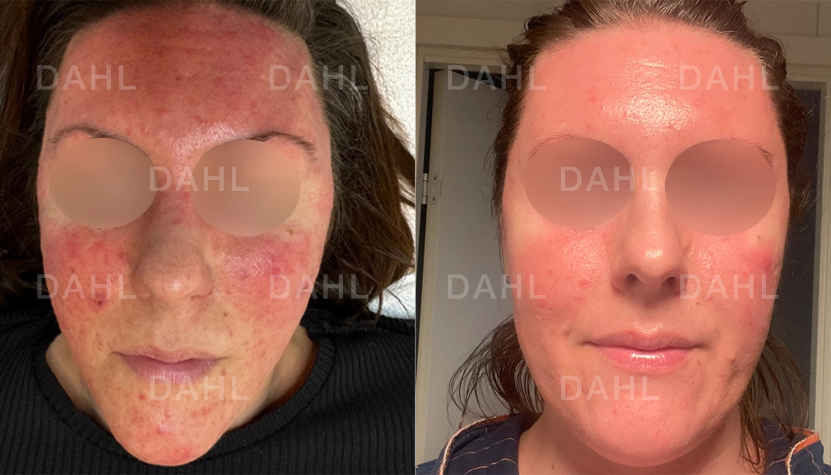 Komplett rosaceabehandling Total hudförvandling vid rosacea