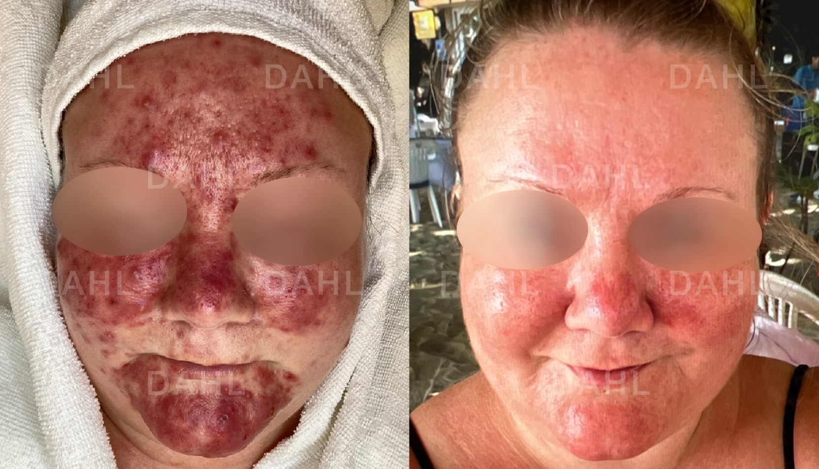 Jämnare hudton vid rosacea Rosacea helhetsresultat - före och efter DAHL Skincare