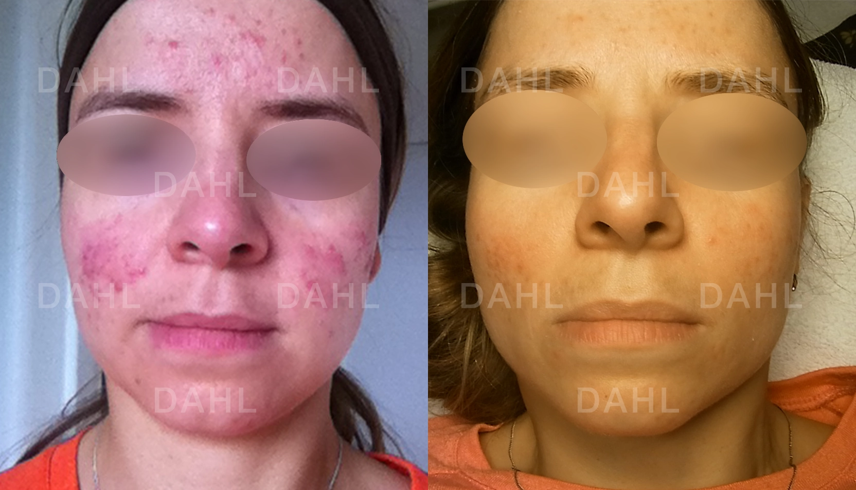 Mindre rodnad på kinder Rosacea på kinder - före och efter