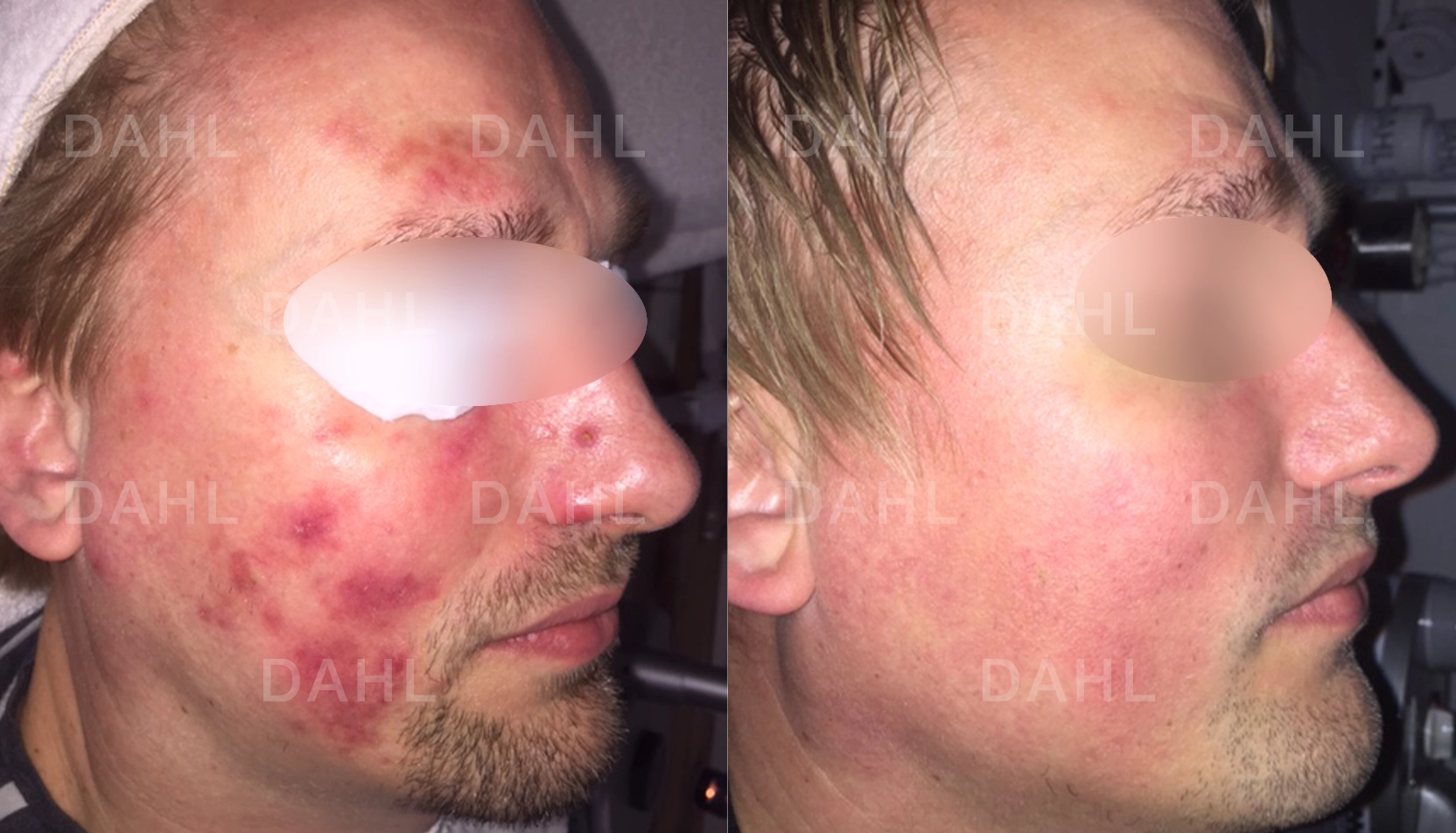 Förbättring vid omfattande rosacea Omfattande rosacea före och efter
