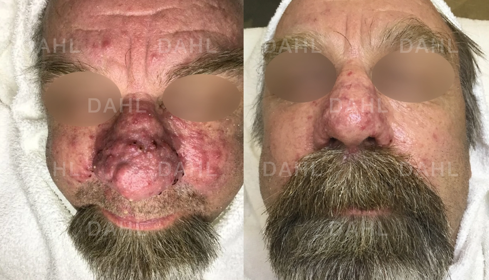 Mindre rodnad på näsan Rosacea på näsan - före efter behandling