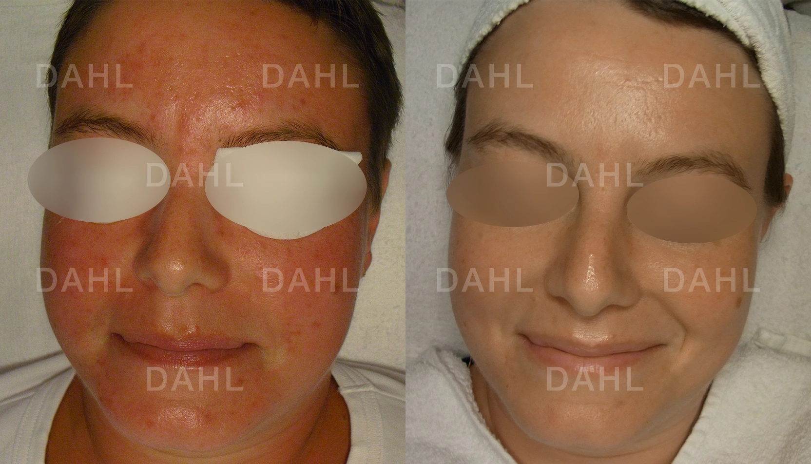 Mindre synlig rosacea-rodnad Minskad rodnad vid rosacea