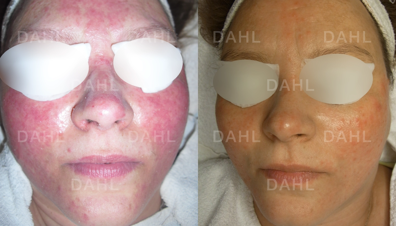 Balanserad svår rosacea Svår rosacea före och efter behandling